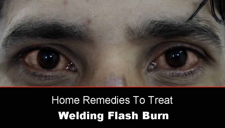 Welding Flash Burn Eyes Home Treatment [12 Simple and Effective Ways]